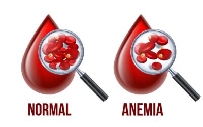 ANAEMIA