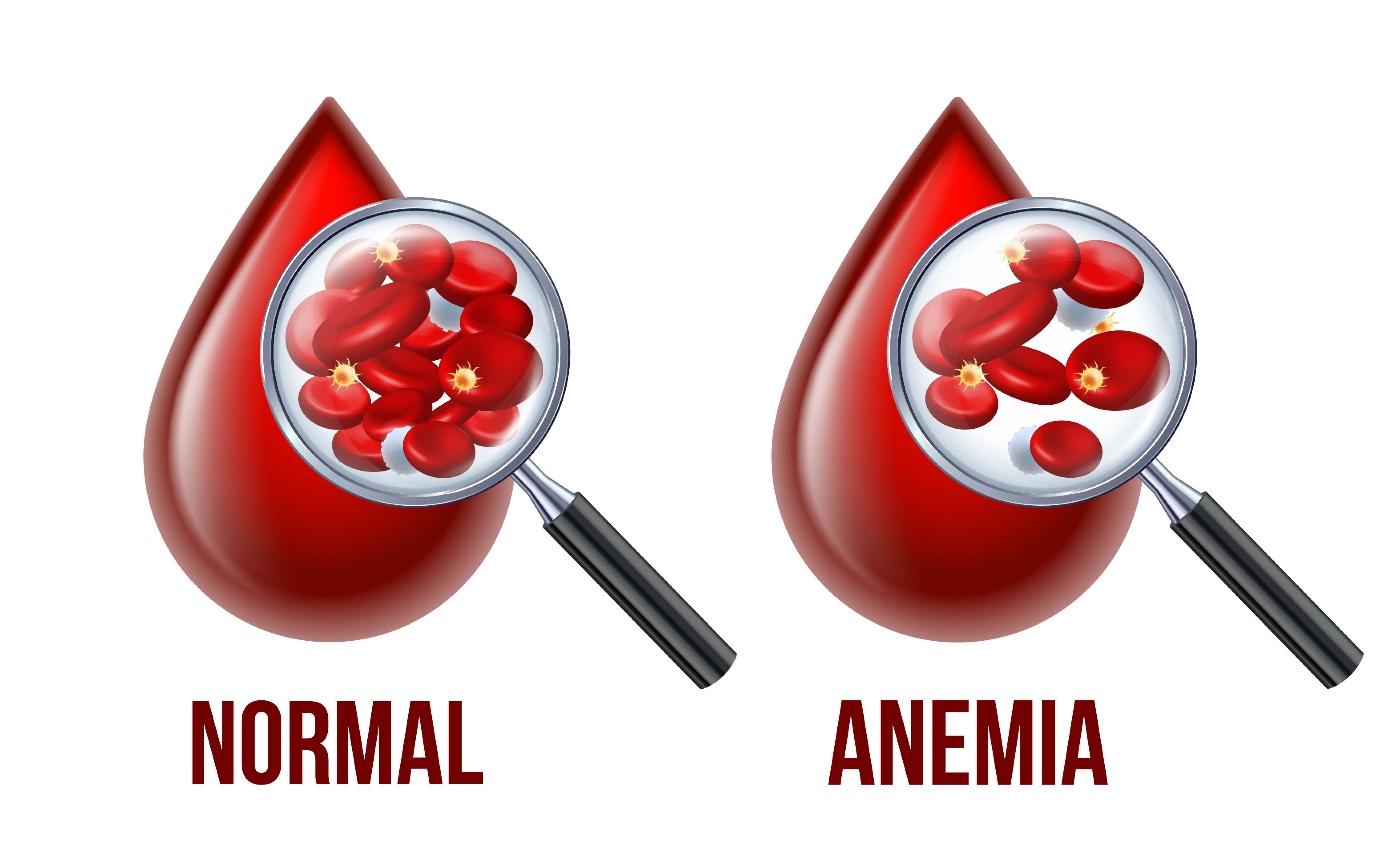 ANAEMIA